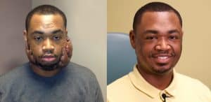 Terrance Griffin before and after keloid removal surgery at UAMS. 