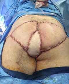 Following pelvic exenteration, the patient was flipped prone to debride the presacral wound and suture the VRAM flap in place.