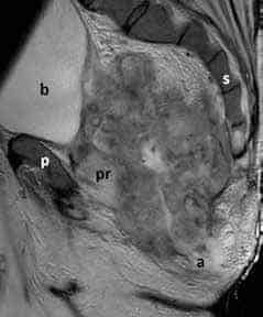 Staging MRI shows a large tumor filling the pelvis invading the prostate (pr) and the anal sphincter (a). Sagittal view showing bladder (b), sacrum (s), and pubis (p)