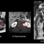 MRI imaging reveals a 3 cm paraspinal tumor arising from the exiting T12 nerve root.