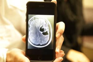 Chris Stephenson's brain tumor was about the size of an orange. He keeps an image of the scan on his phone. 