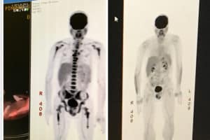 PET scans of Sergio Pinango, 56, of Palm Beach Gardens, Fla., before and after his treatment at the Myeloma Center at depict the areas of his body effected by the rare blood disease before at after his treatment at UAMS.