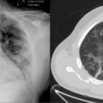 A Chest Radiograph (left) and Computed Tomography (CT) image (right) of the same COVID-19 patient taken one day apart. These UAMS images, now publicly available in the national Cancer Imaging Archive, show COVID-19 lung infection similar to pneumonia. Medical experts refer to the appearance as ground glass opacities, a haziness overlying the lung that is common with COVID-19 patients.
