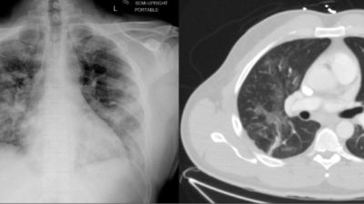 A Chest Radiograph (left) and Computed Tomography (CT) image (right) of the same COVID-19 patient taken one day apart. These UAMS images, now publicly available in the national Cancer Imaging Archive, show COVID-19 lung infection similar to pneumonia. Medical experts refer to the appearance as ground glass opacities, a haziness overlying the lung that is common with COVID-19 patients.