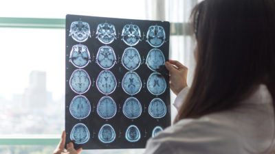 TBI stock photo
