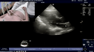 photo of an ultrasound on a normal heartn a normal