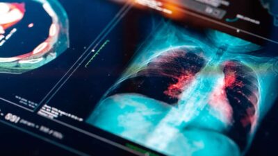 x-ray of a lung