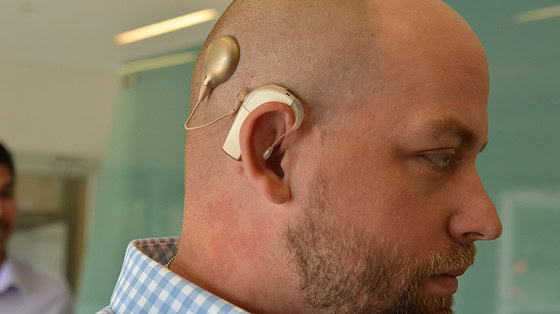 Audiology patient displays cochlear implant device