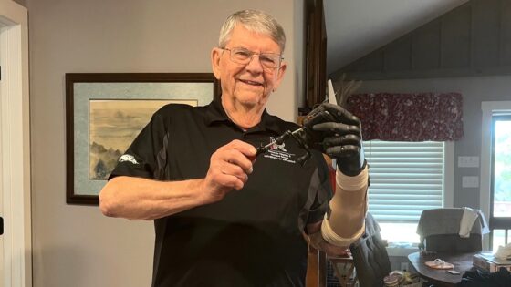 Dewey Hickey was amazed at how his prosthetic hand system helped him repair his bait casting reel.