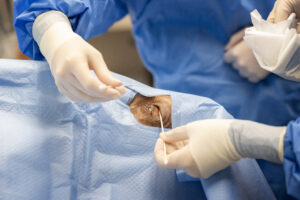 Only Anton Leviticus' eye is visible as he is draped with a cloth during surgery