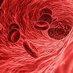 Hemochromatosis