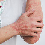 psoriasis