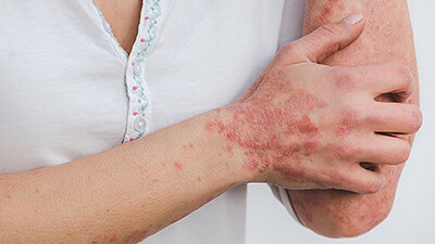 psoriasis
